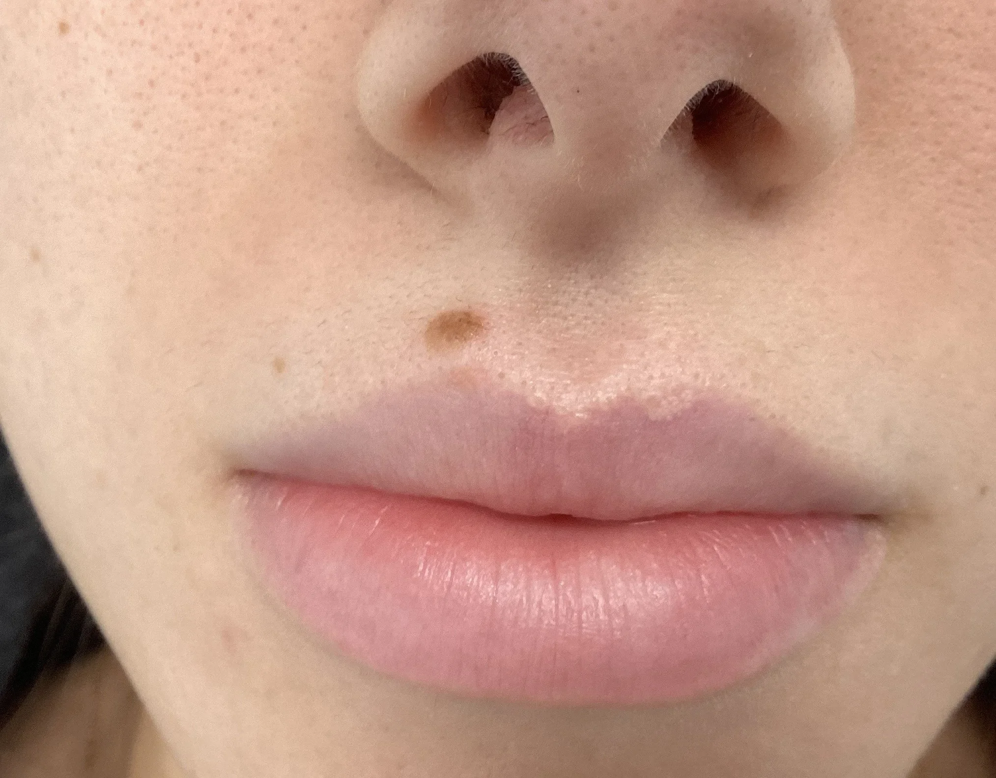 Close-up of a facial mole above the upper lip before electrocautery skin lesion removal