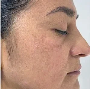 After laser removal procedure photo of a woman’s cheek showing significantly reduced melasma and a more even skin tone