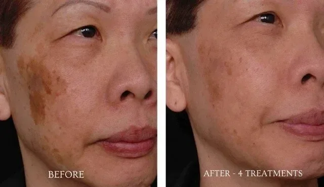 Before and after comparison of a woman’s face showing significant reduction in dark pigmentation patches after 4 laser removal treatments