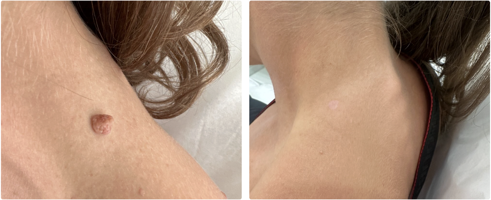Before and after lesion removal