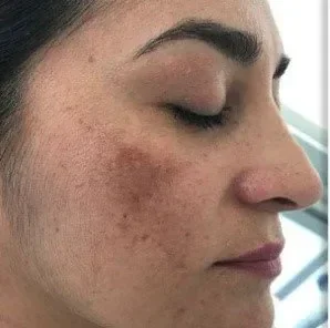 Photo of a woman’s cheek showing visible melasma pigmentation and dark patches before a laser removal procedure