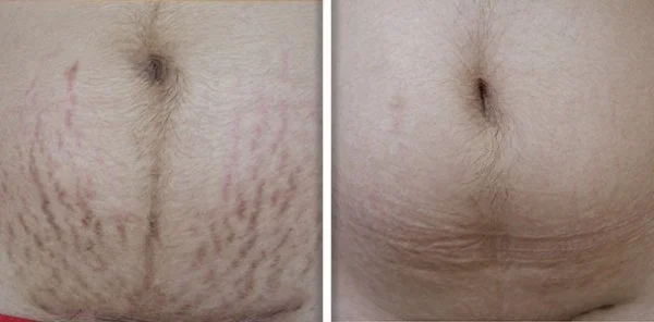 stretchmarks 2.jpg