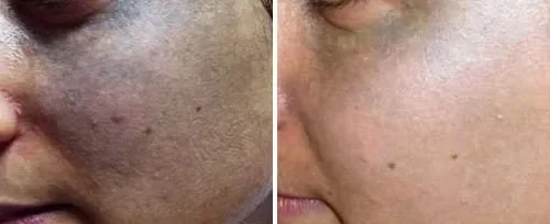 Before and after comparison of a woman’s cheek showing successful laser birthmark and pigmentation removal