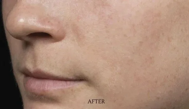After laser removal procedure photo of a woman’s cheek with noticeably fewer freckles and clearer skin