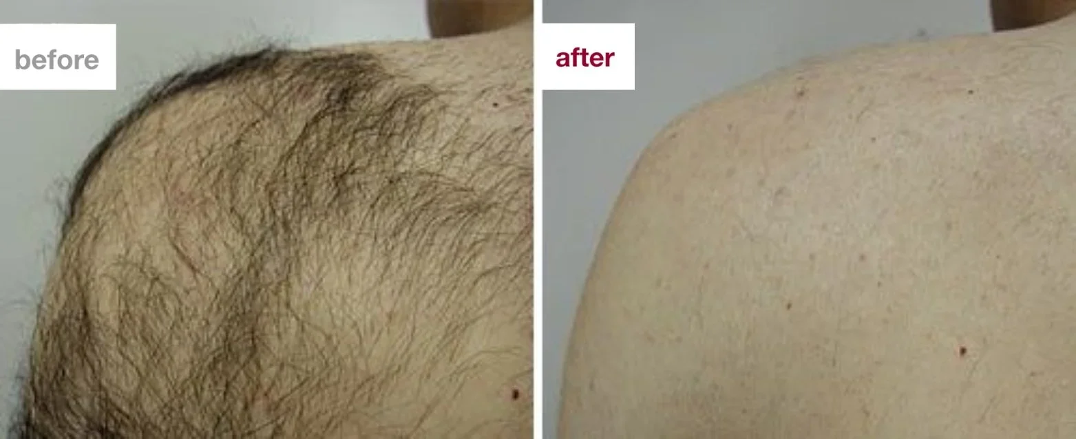 Before and after results of laser hair removal on a man's shoulder, treatment available at Emerald Skin Lab