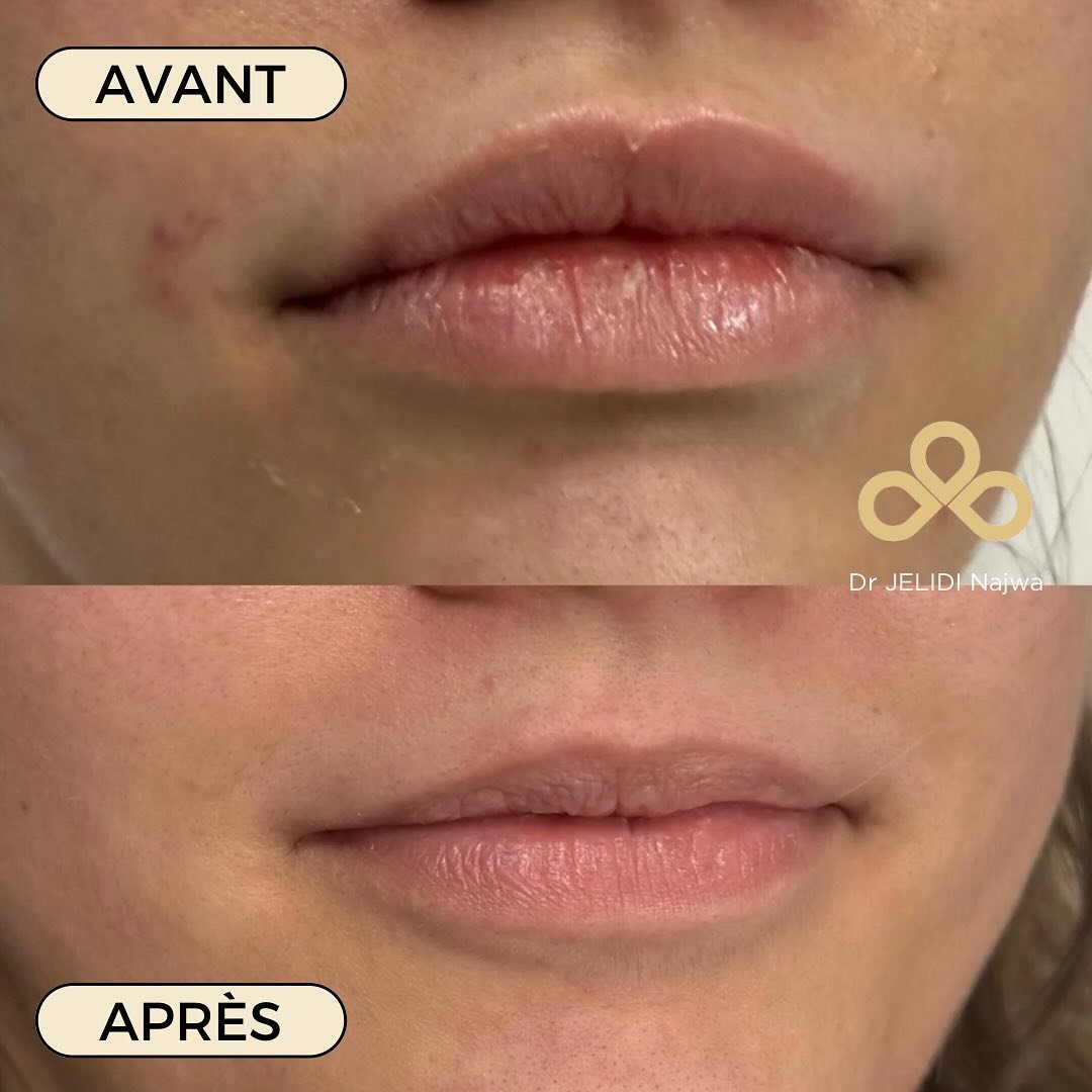 💉 Dissolution de l’acide hyaluronique avec la hyaluronidase !
Ma patiente m’a consultée plusieurs mois après une injection d’acide hyaluronique effectuée à l’étranger.
Elle souhaitait corrig