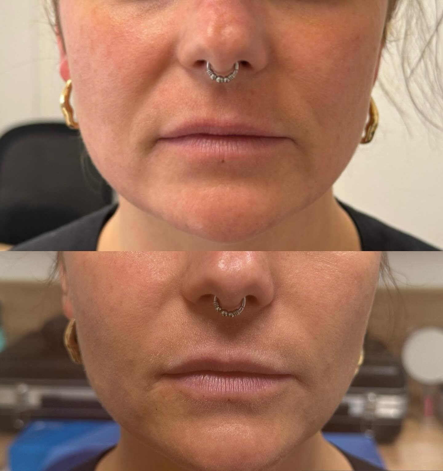 Résultat après injection d’acide hyaluronique au niveau des sillons nasogéniens et des plis d’amertume.
Le visage retrouve des volumes harmonieux et un aspect reposé, tout en préservant un rendu naturel