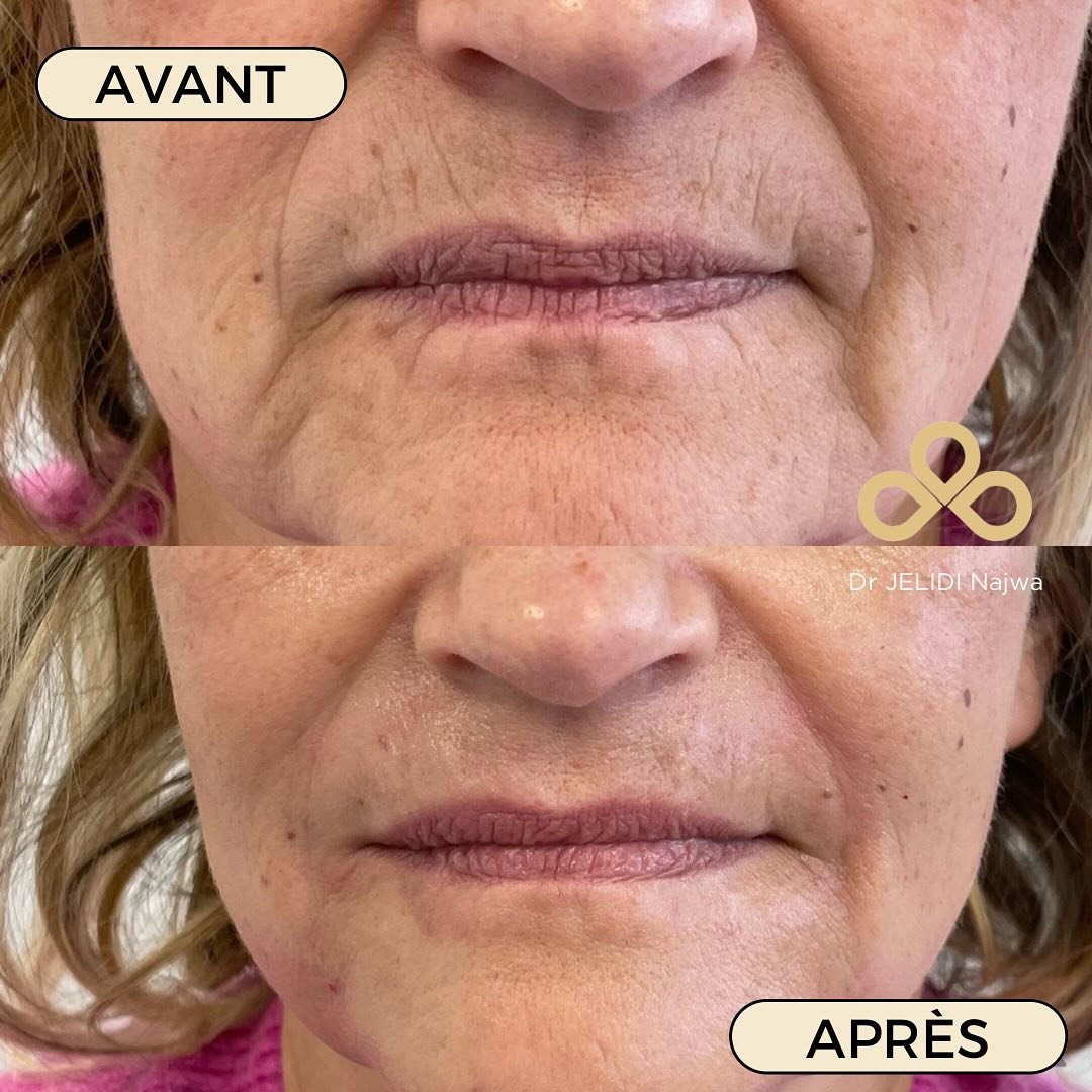 ✨ Résultat après injections d’acide hyaluronique pour atténuer les ridules péri-orales (rides du contour de la bouche).
⠀
Chaque résultat est unique et dépend de l’anatomie de chaque patient, de l