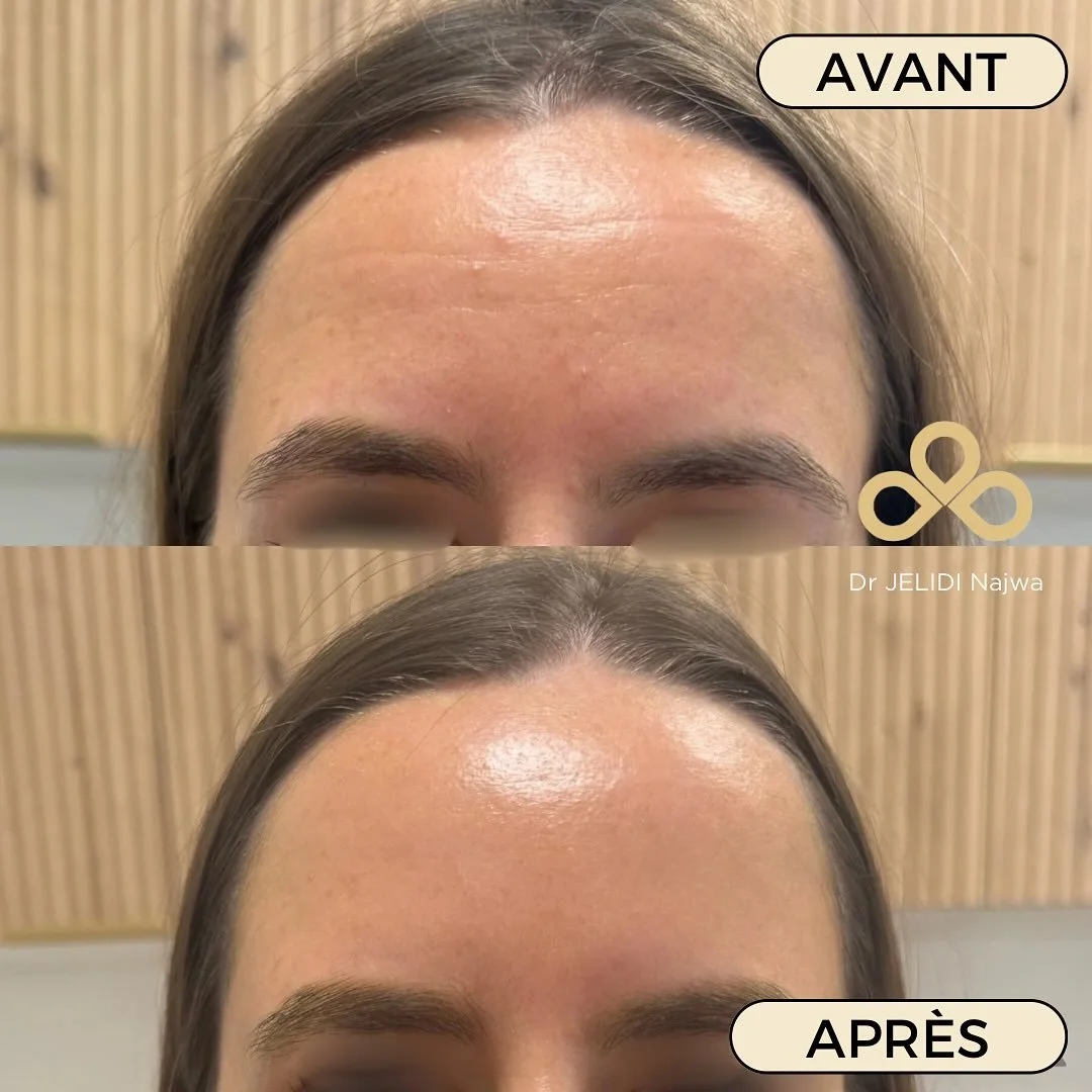 ✨Toxine botulique & rides d’expression débutantes ✨
On ne traite pas « en fonction de l’âge » mais en fonction de l’apparition des rides et de la gêne ressentie par le patient.
Ici, il
