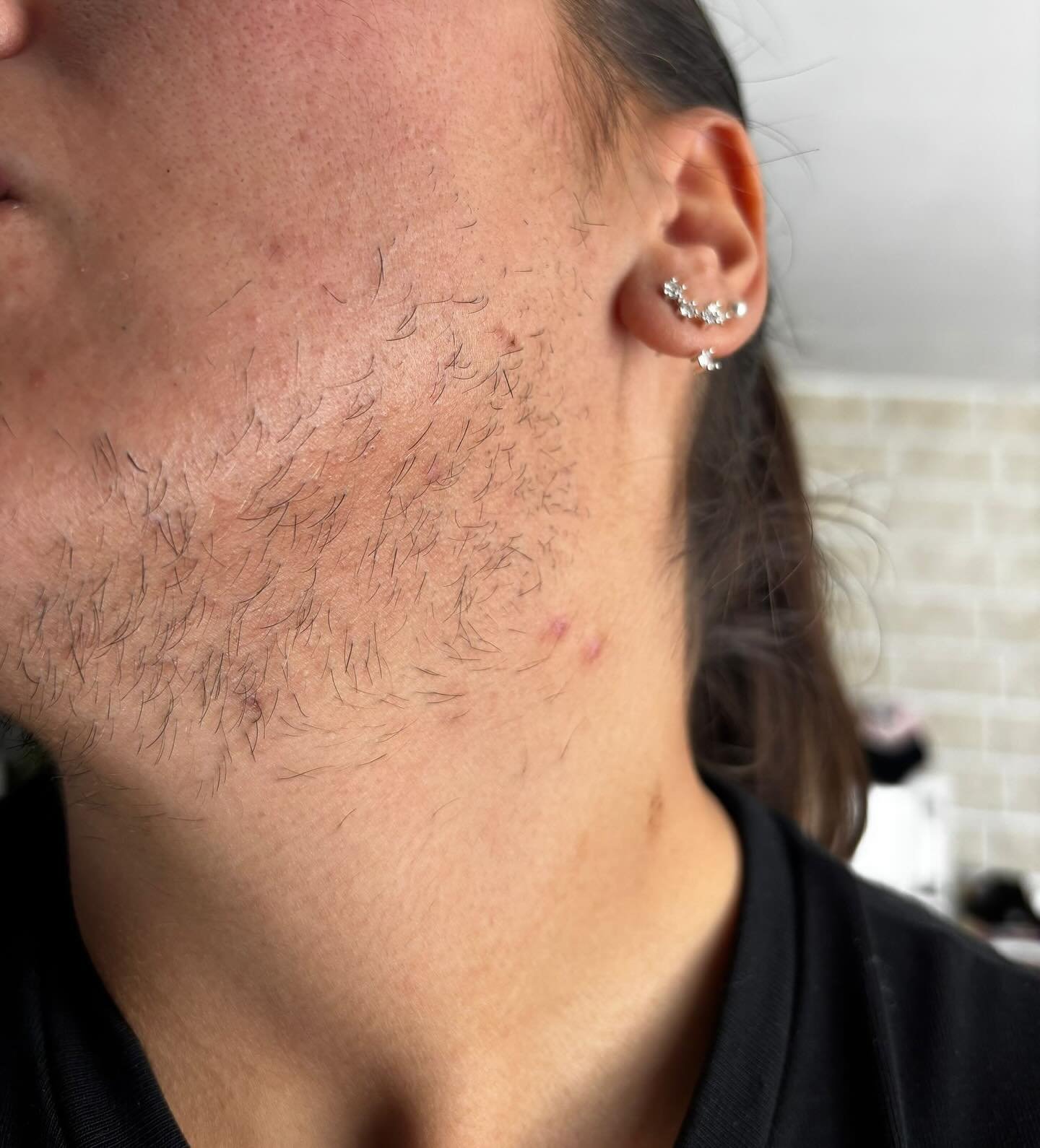 ✨ R&eacute;sultat apr&egrave;s une seule s&eacute;ance d&rsquo;&eacute;pilation au laser &mdash; visage ✨

Sur cette photo avant / apr&egrave;s, on peut observer qu&rsquo;apr&egrave;s une seule s&eacute;ance, la patiente ressent d&eacute;j&agrave; un