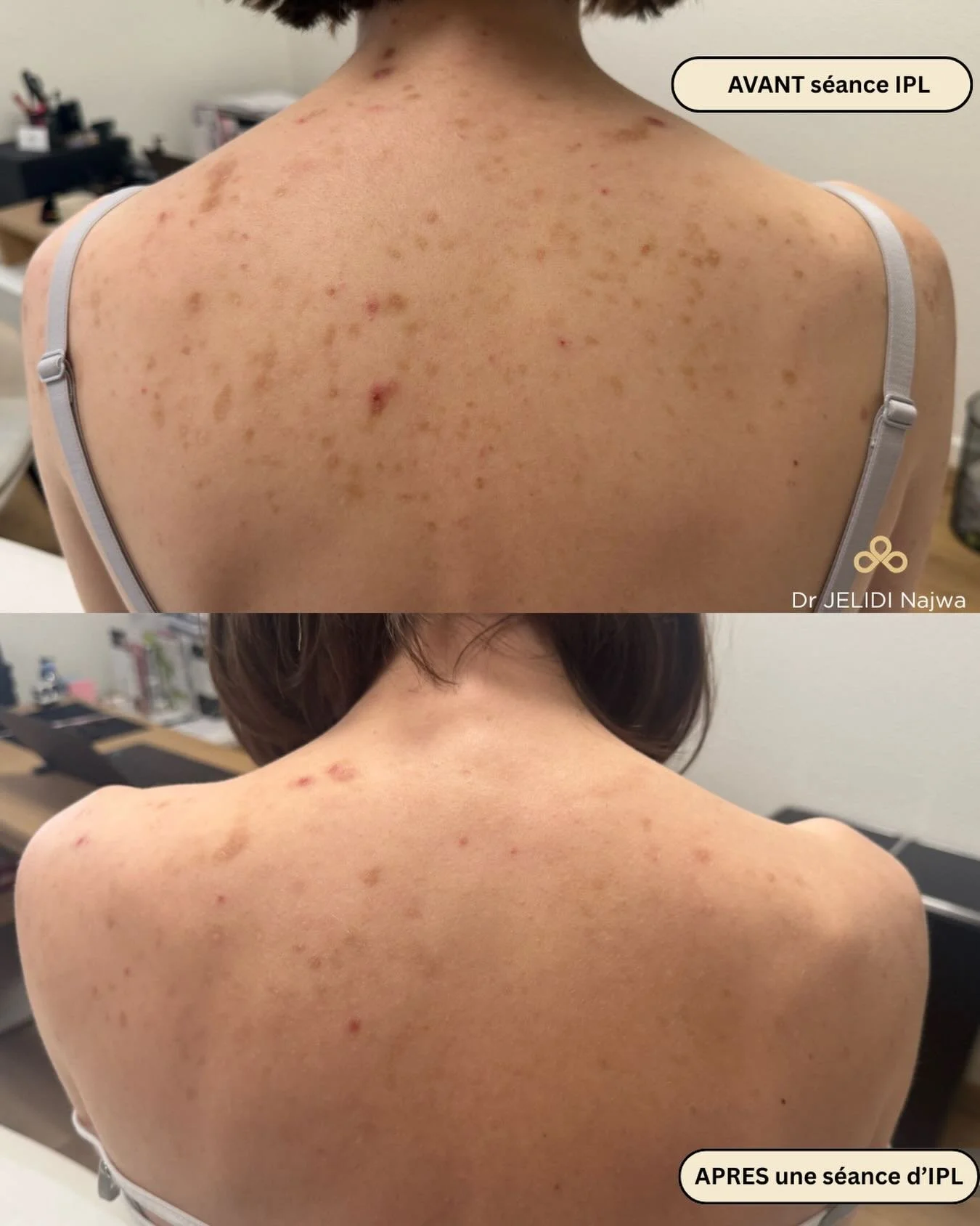 ✨ R&eacute;sultat apr&egrave;s 1 seule s&eacute;ance d&rsquo;IPL ✨

Plus de 50 % des hyperpigmentations post-inflammatoires (post-acn&eacute;) att&eacute;nu&eacute;es d&egrave;s la premi&egrave;re s&eacute;ance 👏
Une seconde s&eacute;ance a &eacute;