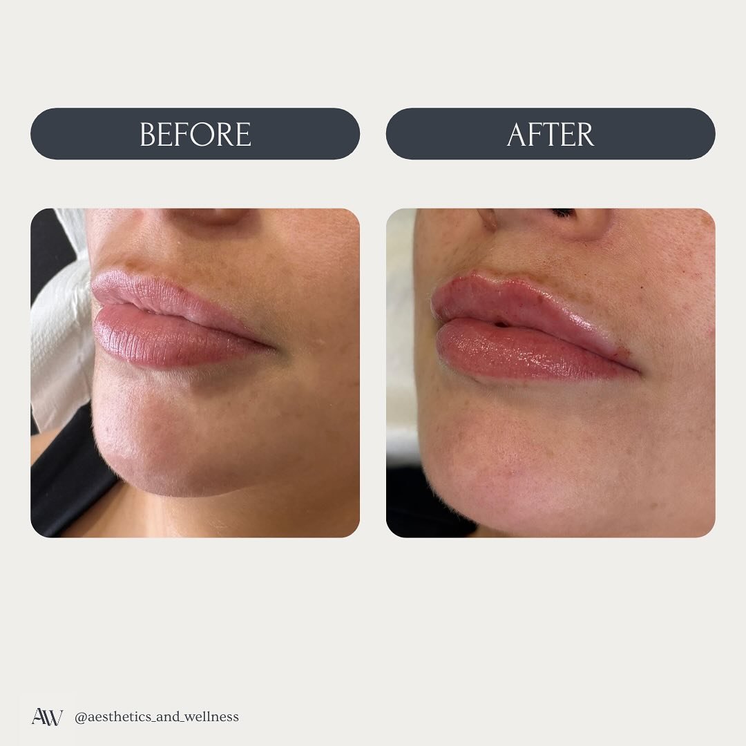 ❤️Lip Enhancement ❤️
Just made some subtle adjustments, mostly to the top lip to even out the shape and create a bit of height