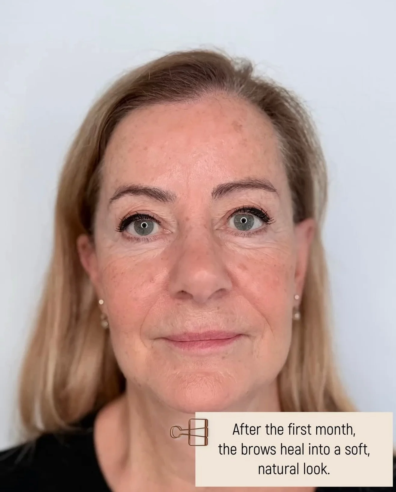 ✨ Hyperrealistic brows &ndash; the process ✨
In this carousel, I&rsquo;m taking you through the full journey of hyperrealistic brows &mdash; from the first month after the treatment to up to a year and a half later. You&rsquo;ll see how the results g