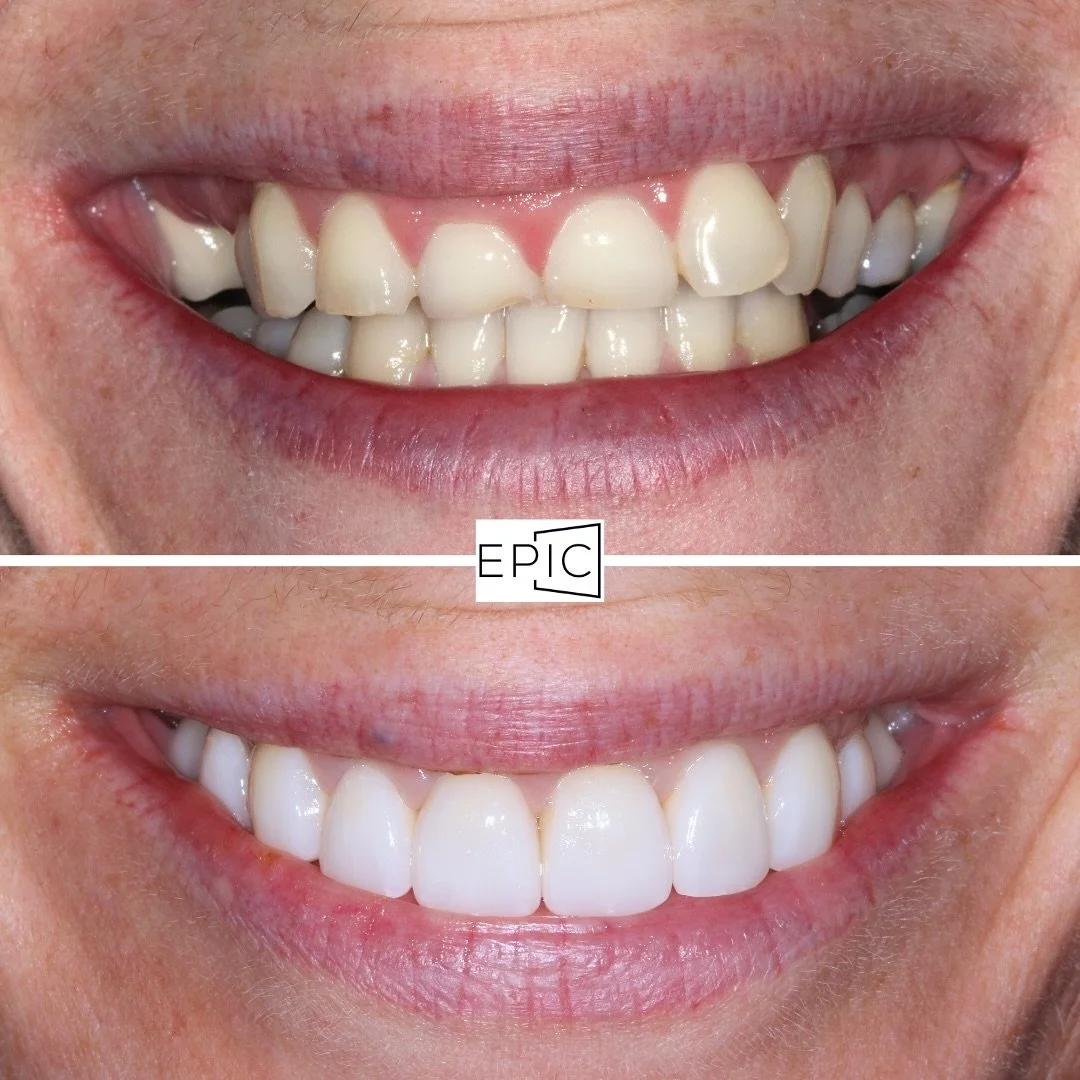 Imagine being able to do minimally invasive dentistry utilizing the power of orthodontics and CEREC technology? 

Having the end in mind is critical in the success of the case! Each of these restorations were milled in house and stain and glazed! 

&