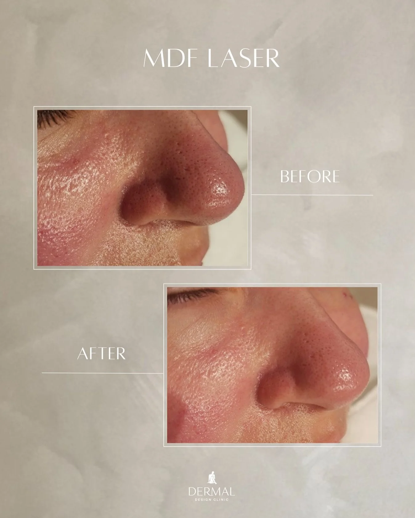 Refined. Radiant. Renewed.
 MDF Laser works beneath the surface to minimise the appearance of pores, smooth skin texture, and restore clarity&mdash;without the downtime.

These results speak for themselves: a fresher, more luminous complexion after j