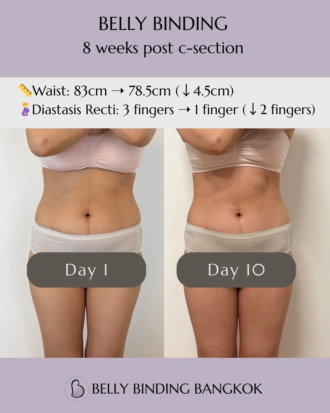 ✨ 10 Days of Belly Binding &ndash; 8 Weeks Post C-section ✨

Real results from one of my lovely clients:
📏 Waist: 83cm ➝ 78.5cm (-4.5cm)
🤰 Diastasis Recti: 3 fingers ➝ 1 finger (-2 fingers)
💆&zwj;♀️ Plus, better posture and feeling more supported 