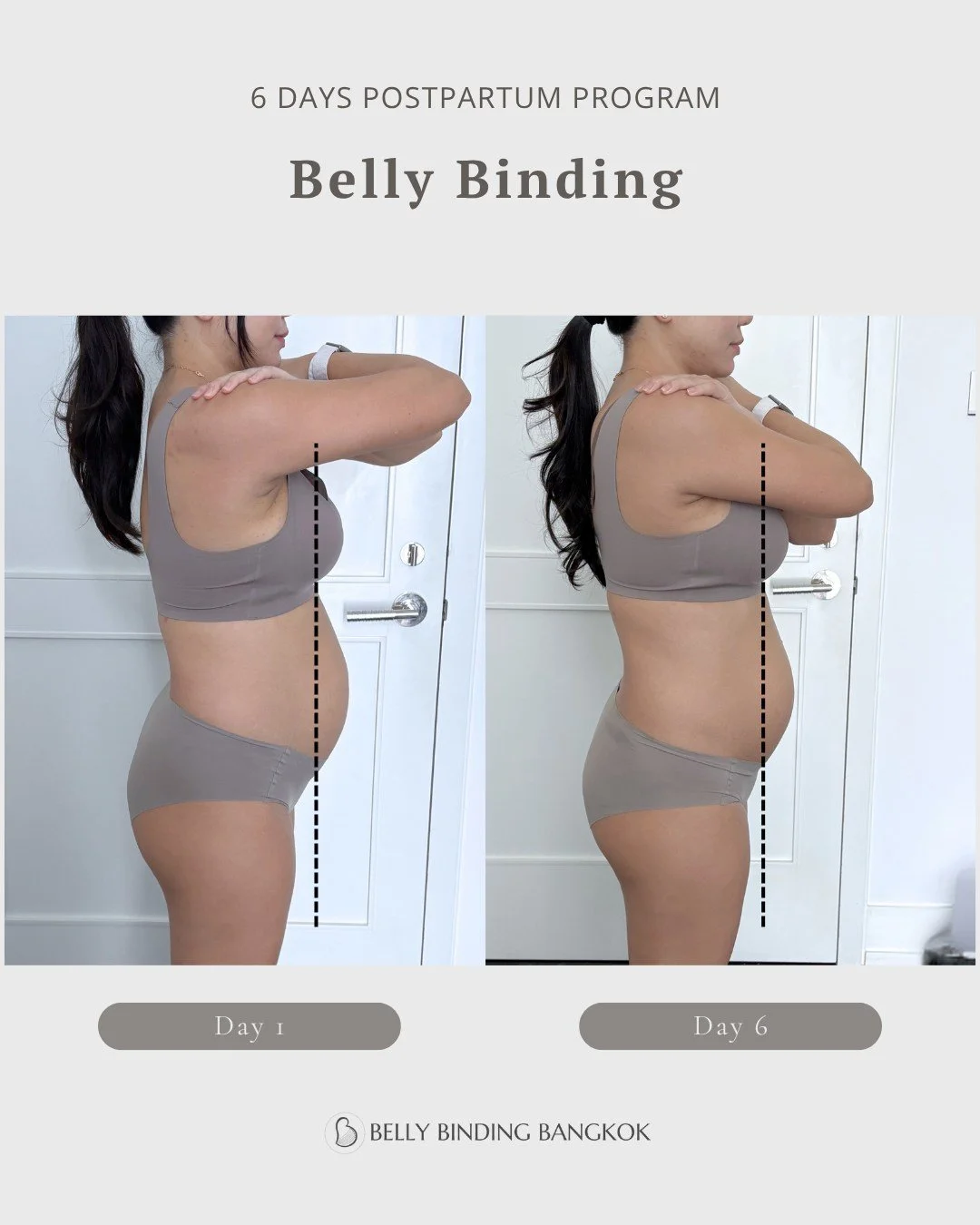At 3 months postpartum (C-section), healing is still very possible 🤍

After 6 days:
&bull; Diastasis recti improved from 3 fingers to 1
&bull; Visible reduction in bloating
&bull; Better core support

It&rsquo;s not just about how it looks &mdash; i