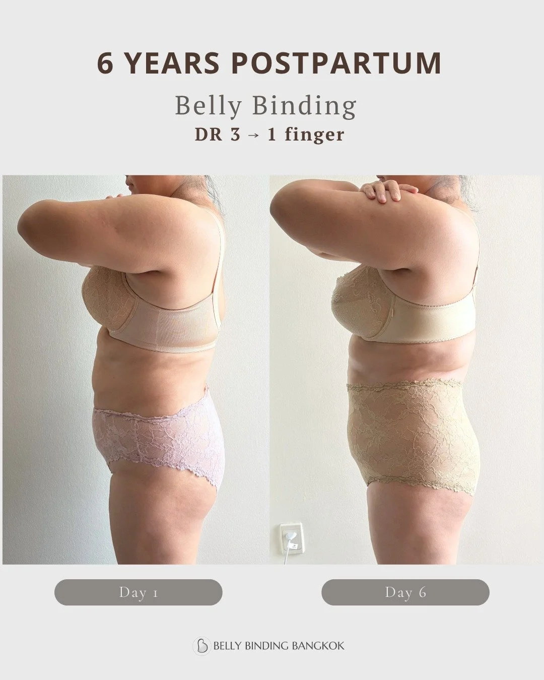 6 years postpartum &mdash; and her body was still capable of change. ✨

When she first came to me, she had a 3-finger abdominal separation (DR), ongoing bloating, and felt disconnected from her core.

After 6 days of belly binding + guided breathing 