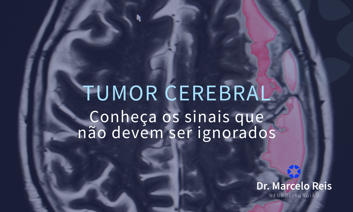 Tumor cerebral: conheça os sinais que não devem ser ignorados