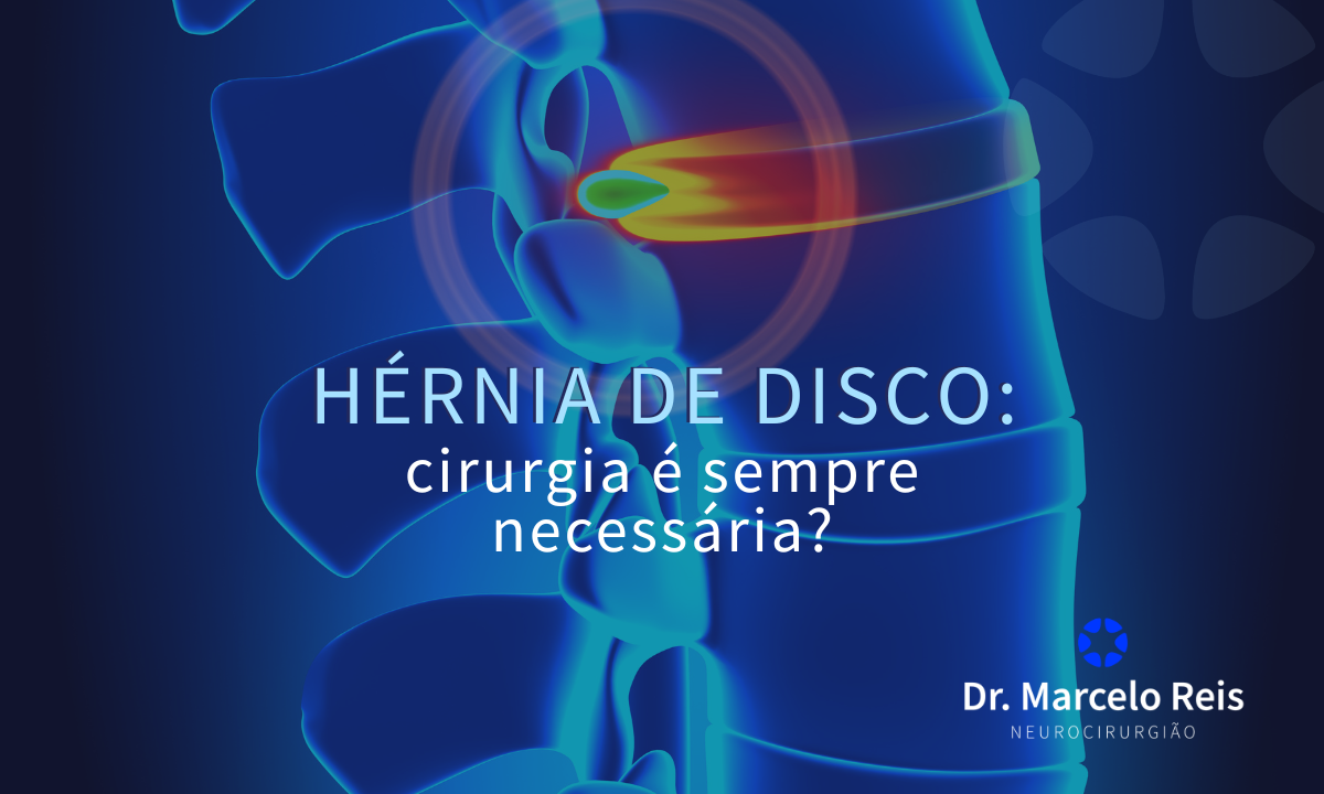 Hérnia de disco: cirurgia é sempre necessária?