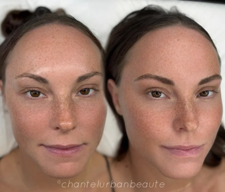 Nanostroke brows is a beautiful effect to integrate with your own natural brows if they are sparse, lacking shape, thinning out, or missing areas of hair and more!

This style is very natural that mimics realism of brow hairs to seamlessly blend into