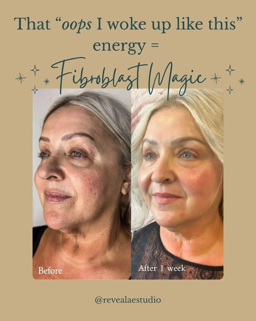 Fibroblast helps tighten, lift, and smooth the skin by stimulating your body&rsquo;s natural collagen, giving you that refreshed, didn&rsquo;t-even-try glow.
It&rsquo;s the secret behind skin that looks airbrushed in real life, without injectables or