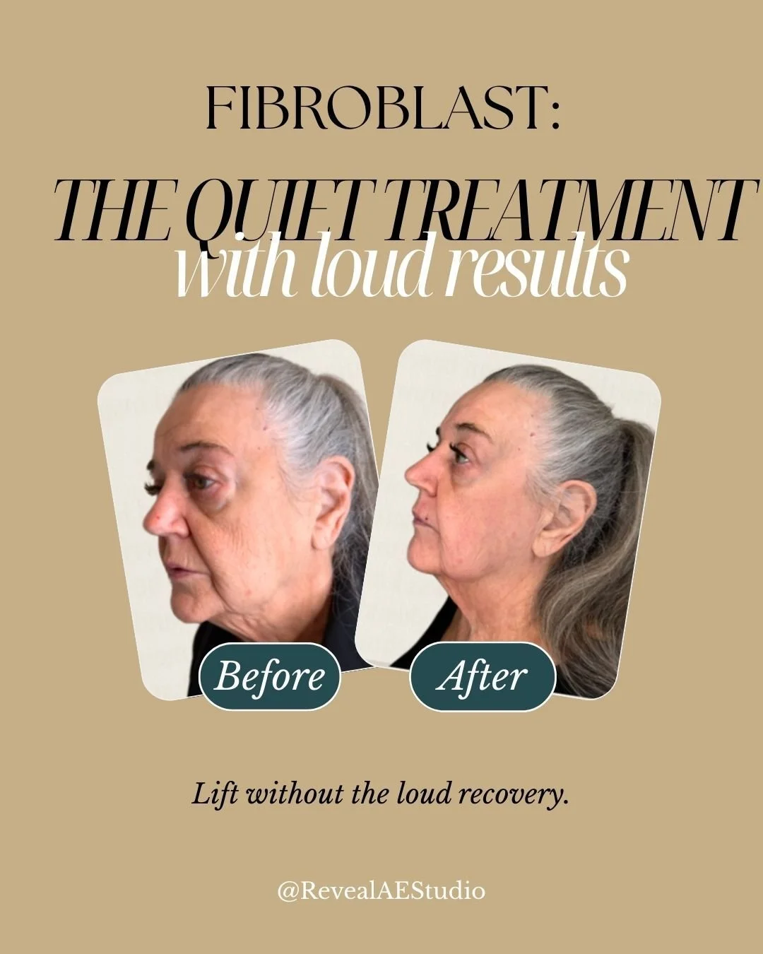 Fibroblast delivers a noticeable, natural lift- without surgery or downtime. It&rsquo;s the glow-up that whispers results and speaks volumes through confidence. 

DM us with any questions, or book using our website, revealaestudio.com. Watch your ski