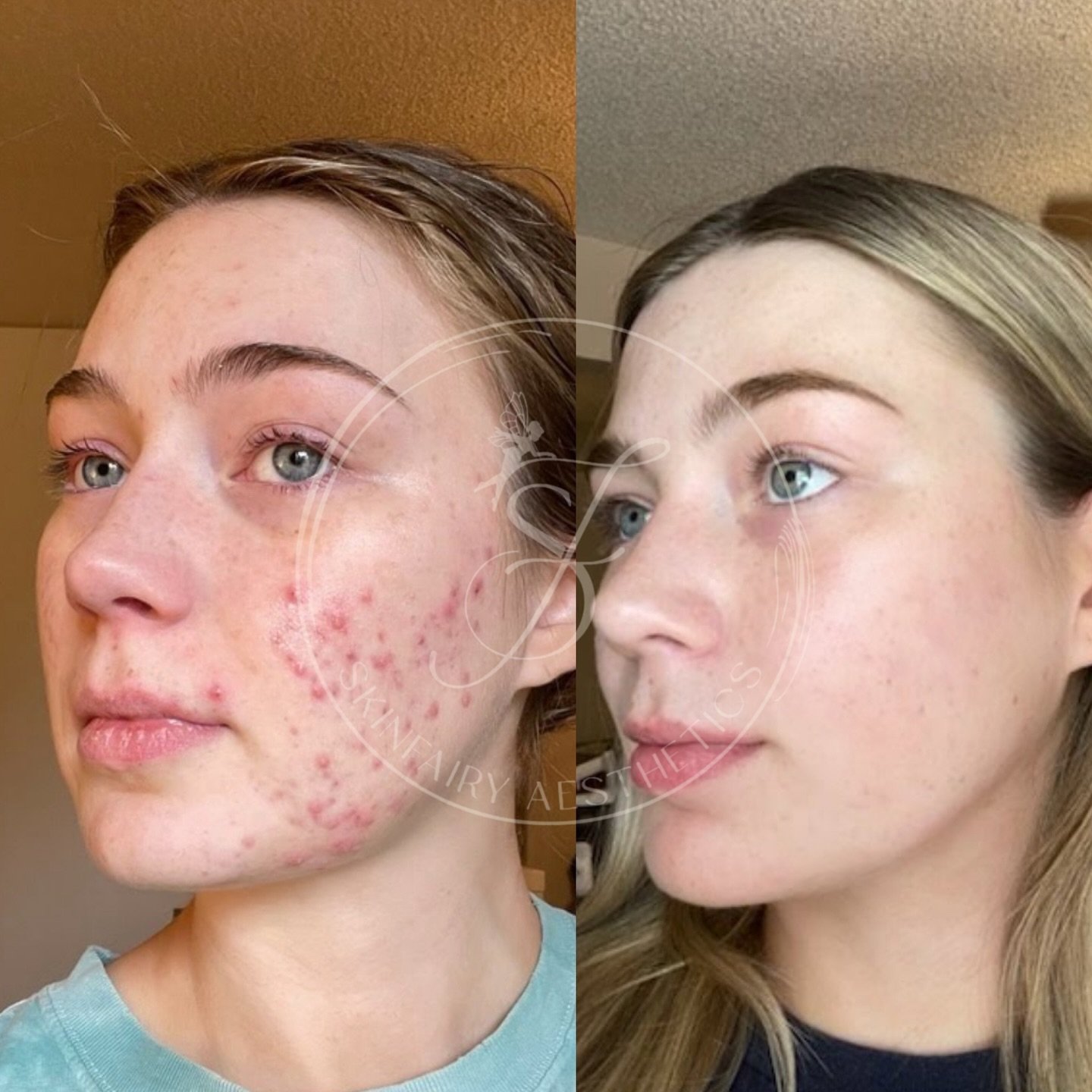 Skin Fairy Magic 🧚&zwj;♀️💫💫💫

#azskin #azfacial #azesthetician #phoenixskin #phoenixfacial #acneresults #azacne