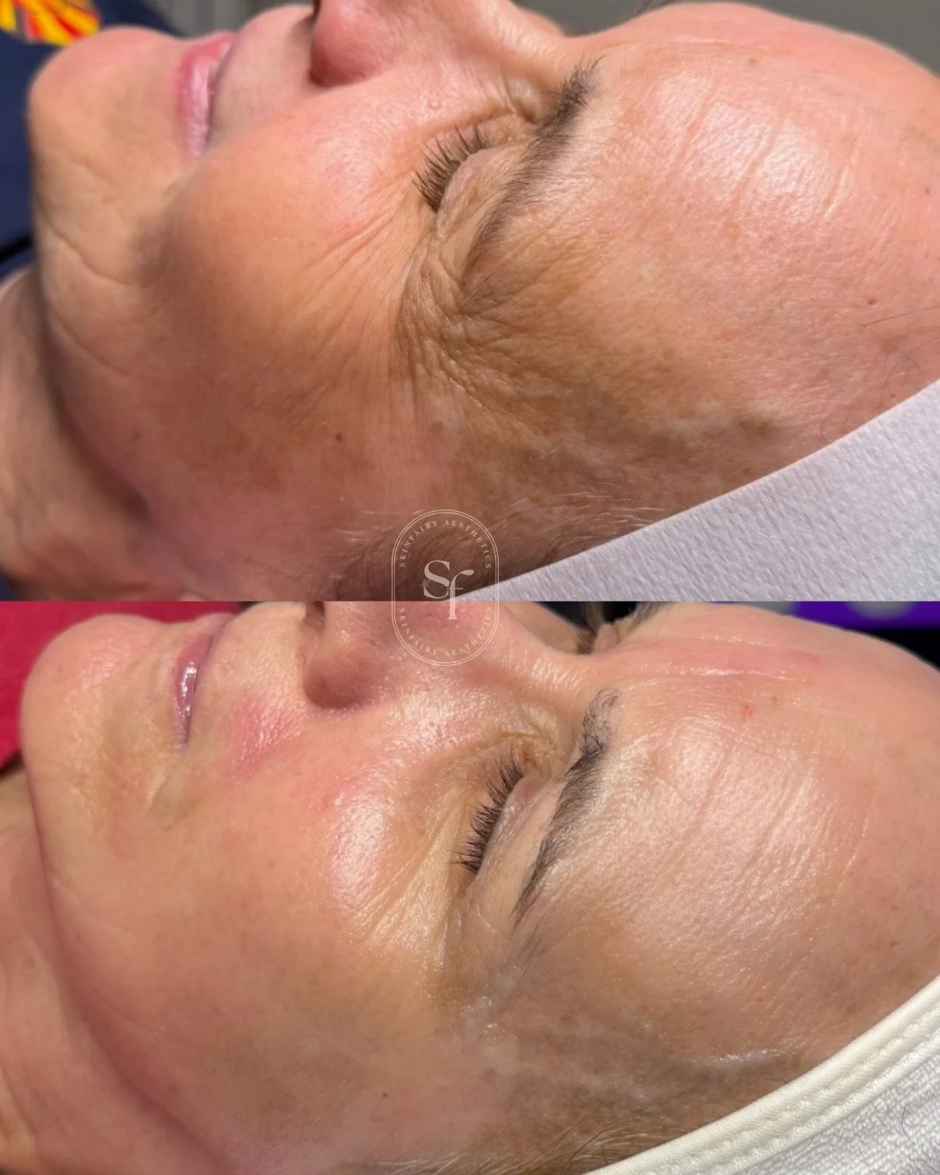 Would you believe me if I told you these results are just her own stimulated collagen production? 🧐 

Some people do not want to dabble into injections or heavy lasers and this beautiful client is one of those people. We performed three Skin Pen mic