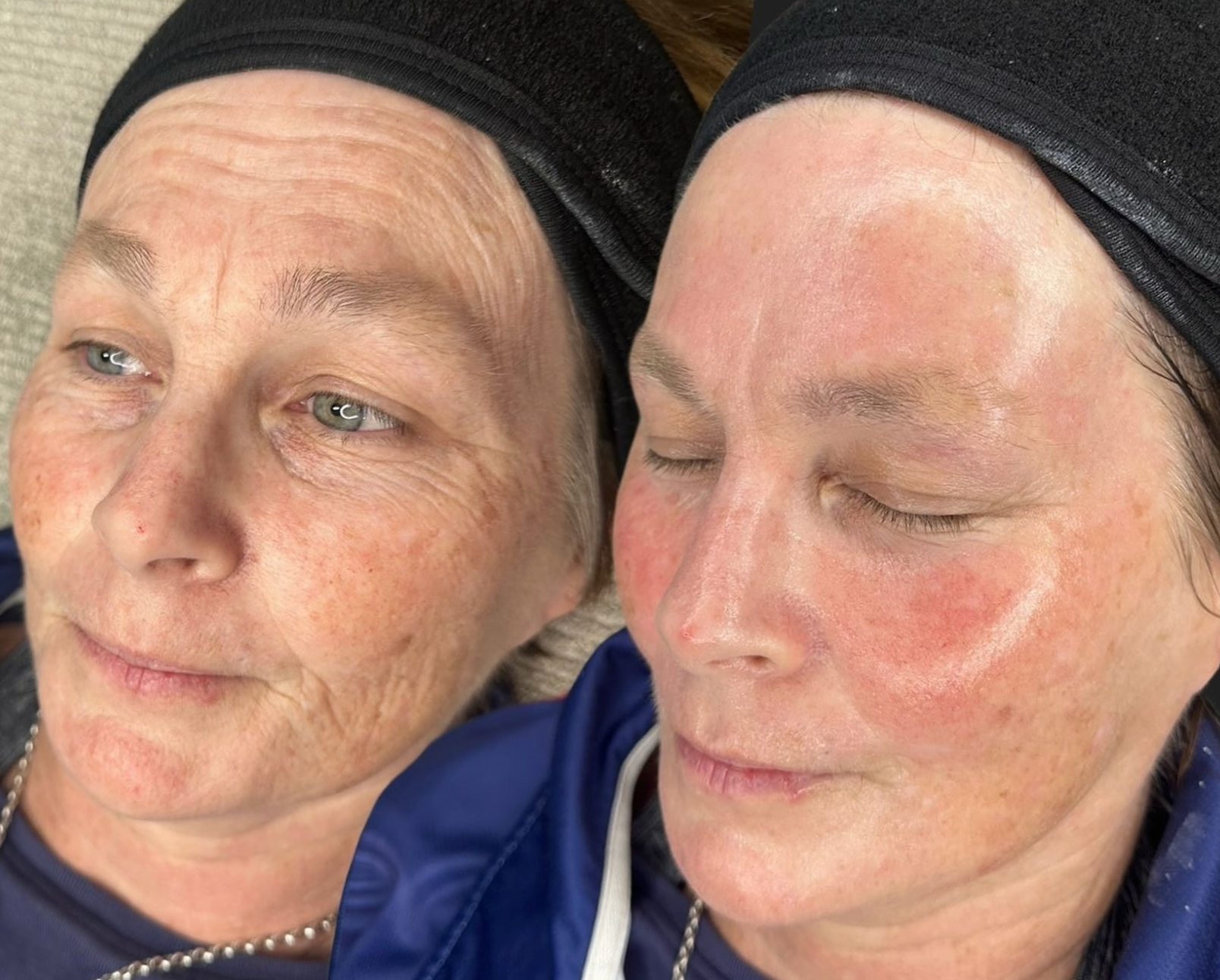 Before and After Korean Glass Glow facial treatment at Skin Fairy Aesthetics, North Phoenix