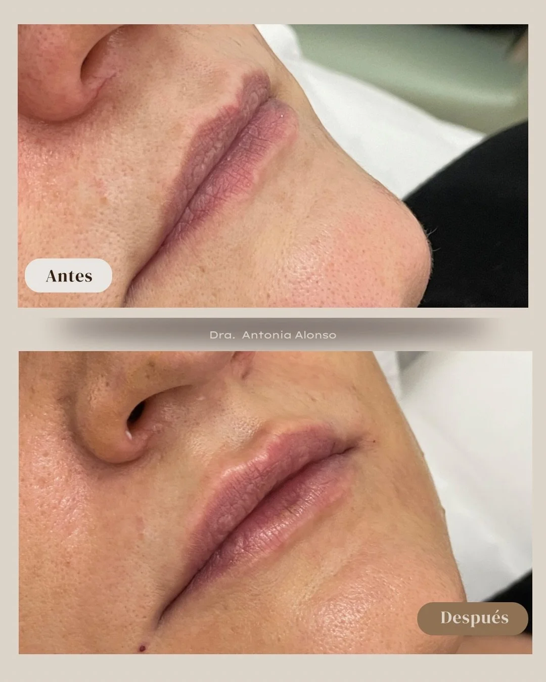 Tratamos cada labio de manera totalmente personalizada. 
&iquest;Qu&eacute; podemos mejorar?
🔸El volumen
🔸Podemos perfilar 
🔸La sonrisa gingival
🔸La hidrataci&oacute;n 

#labioshidratados #labiosbonitos #medicinaestetica #barcelona #draantoniaalo