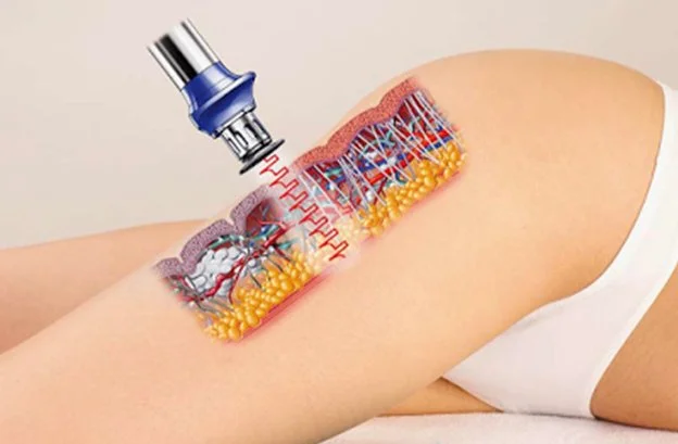 Celulitis: por qué aparece y cómo las ondas de choque pueden ayudarte a mejorar el aspecto de tu piel