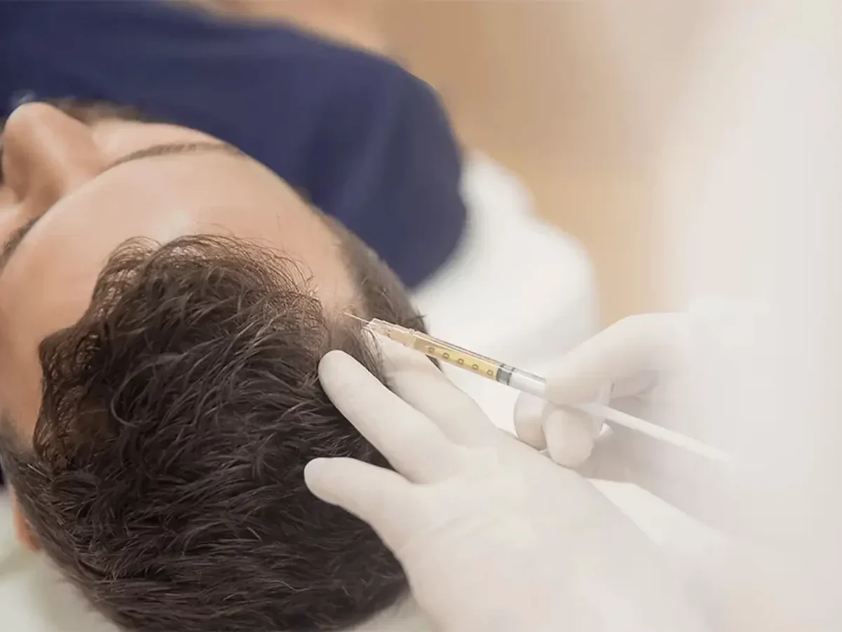 Tratamiento PRP Cabello