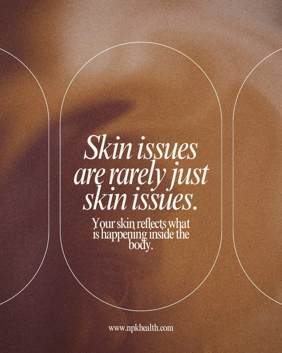 For years I struggled with acne.

I tried the typical things most people try. Prescriptions medication, topicals, skincare routines, different products, and even medications. Some things helped temporarily, but the breakouts always came back.
What I 