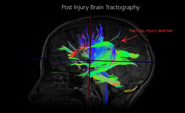 Post-Injury Brain Tractography