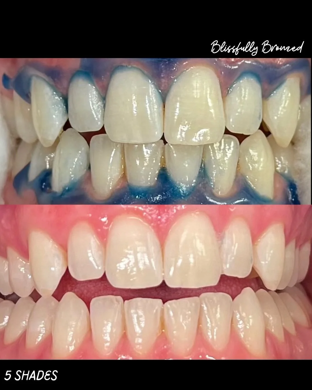 Always wanted to try teeth whitening?
Now&rsquo;s the time &mdash; intro pricing is $79. ✨

Our goal isn&rsquo;t &ldquo;fake white,&rdquo; it&rsquo;s your natural enamel color.
Everyone&rsquo;s results vary, and that&rsquo;s normal.

&bull; Targets t