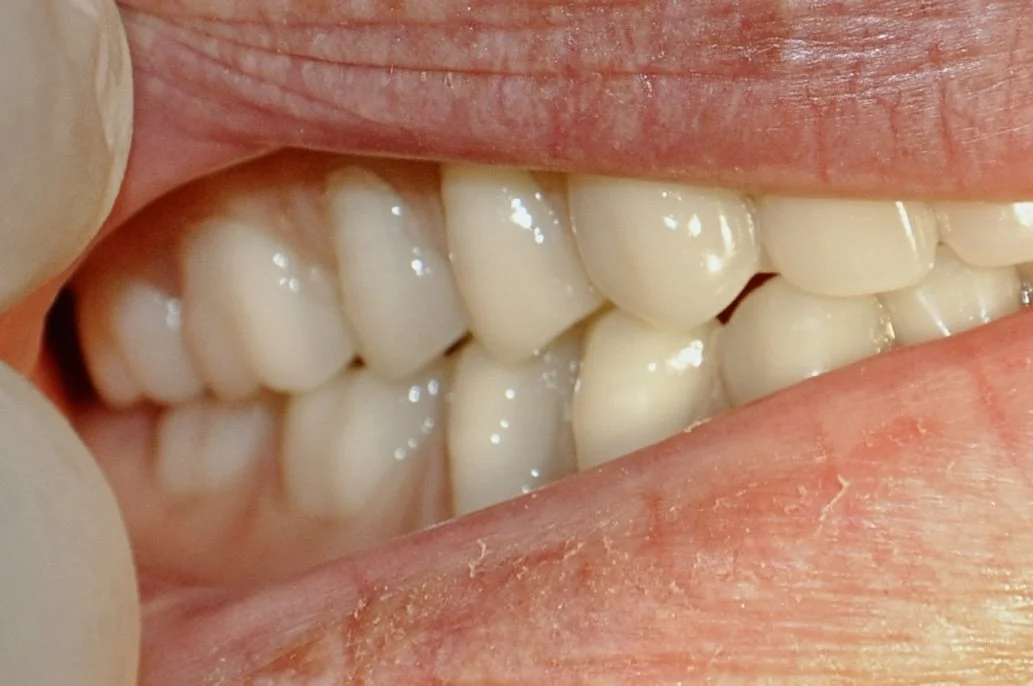 An image of a perfect fitting, accurate interdigitation and optimal occlusion between the patients upper and lower denture. 