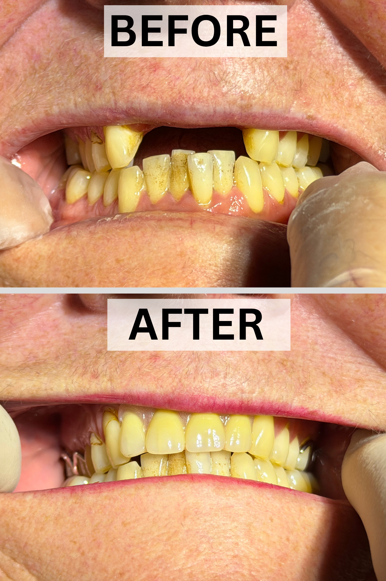 A smile completely transformed. 😀
By utilising our revolutionary QiQit System and premium QiQdent products, this patient received a custom, state-of-the-art partial denture.
The result? A comfortable, lifelike fit engineered to her unique dimensions