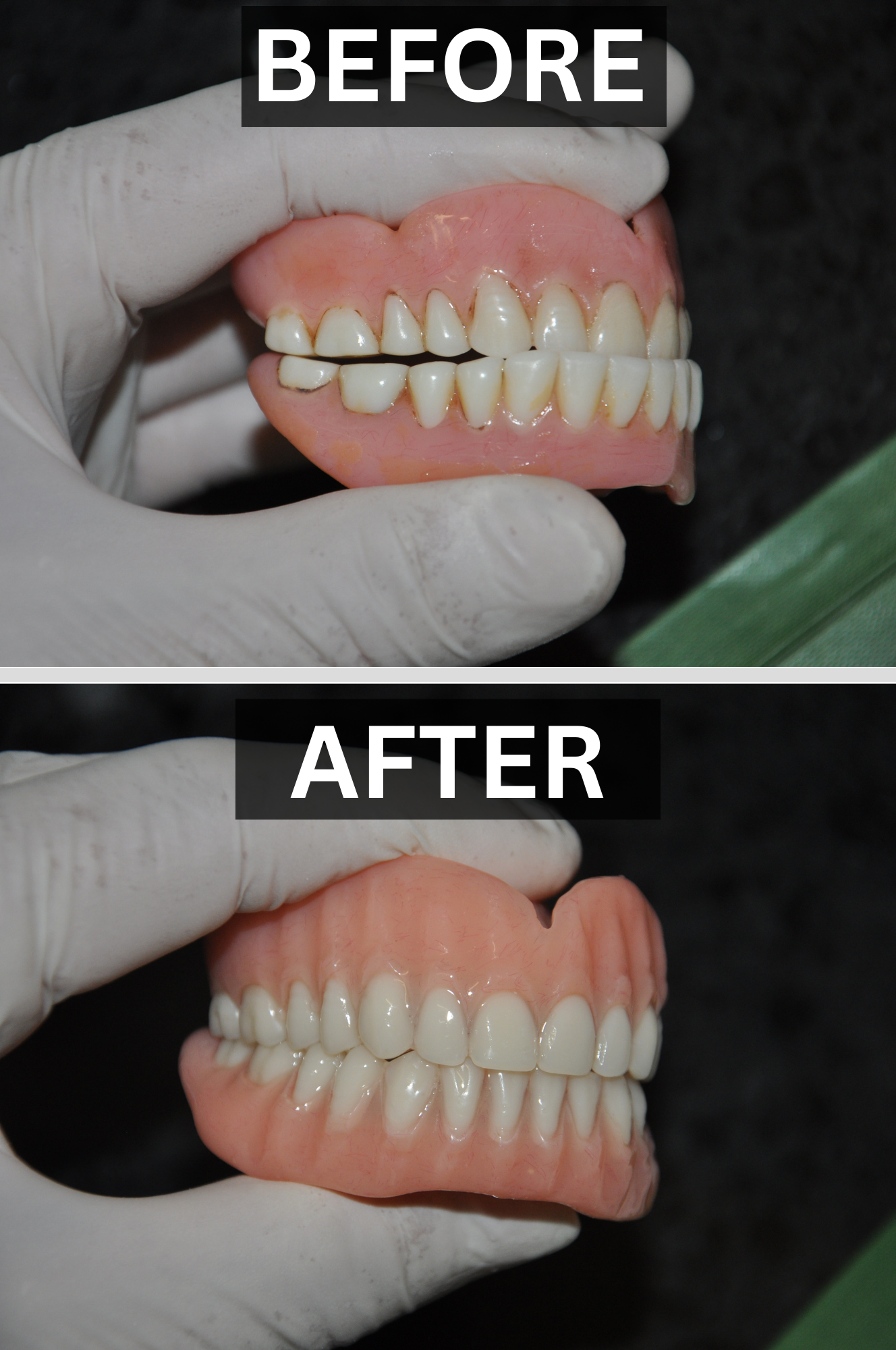 Before and after comparison showing a worn old denture replaced by a brand new, custom-made denture created from the ground up by Dr Sebastian Riggio in Melbourne utilising the QiQit System for a precise fit.