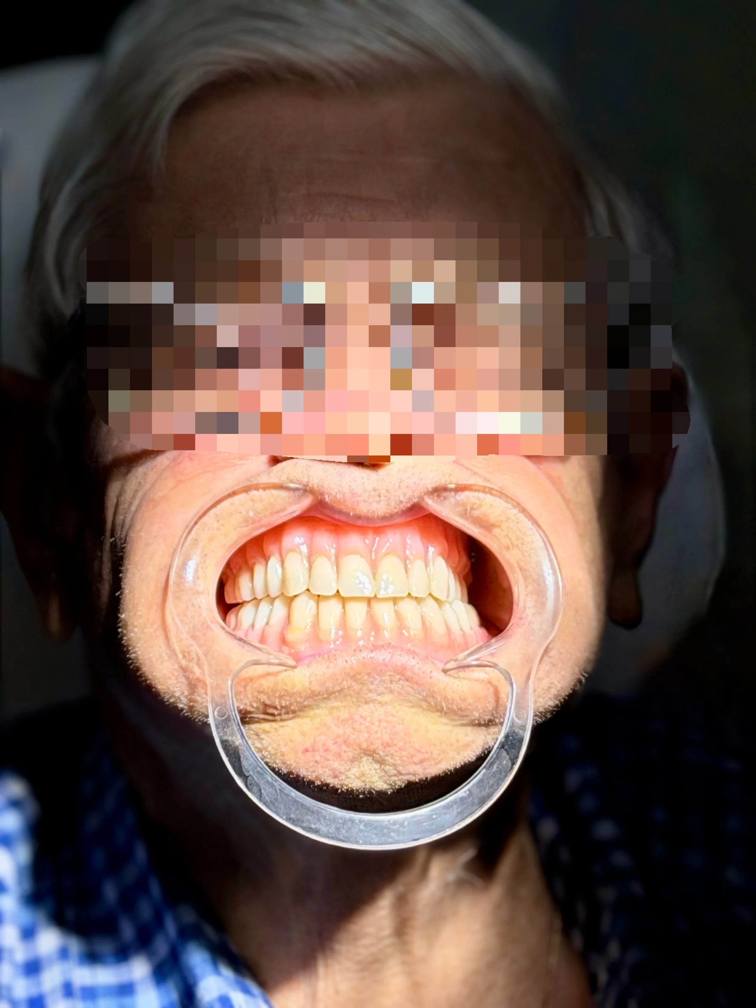 A complex case, where we had to create a full upper denture and a partial lower denture around 4 implant teeth which were put in on an angle. 