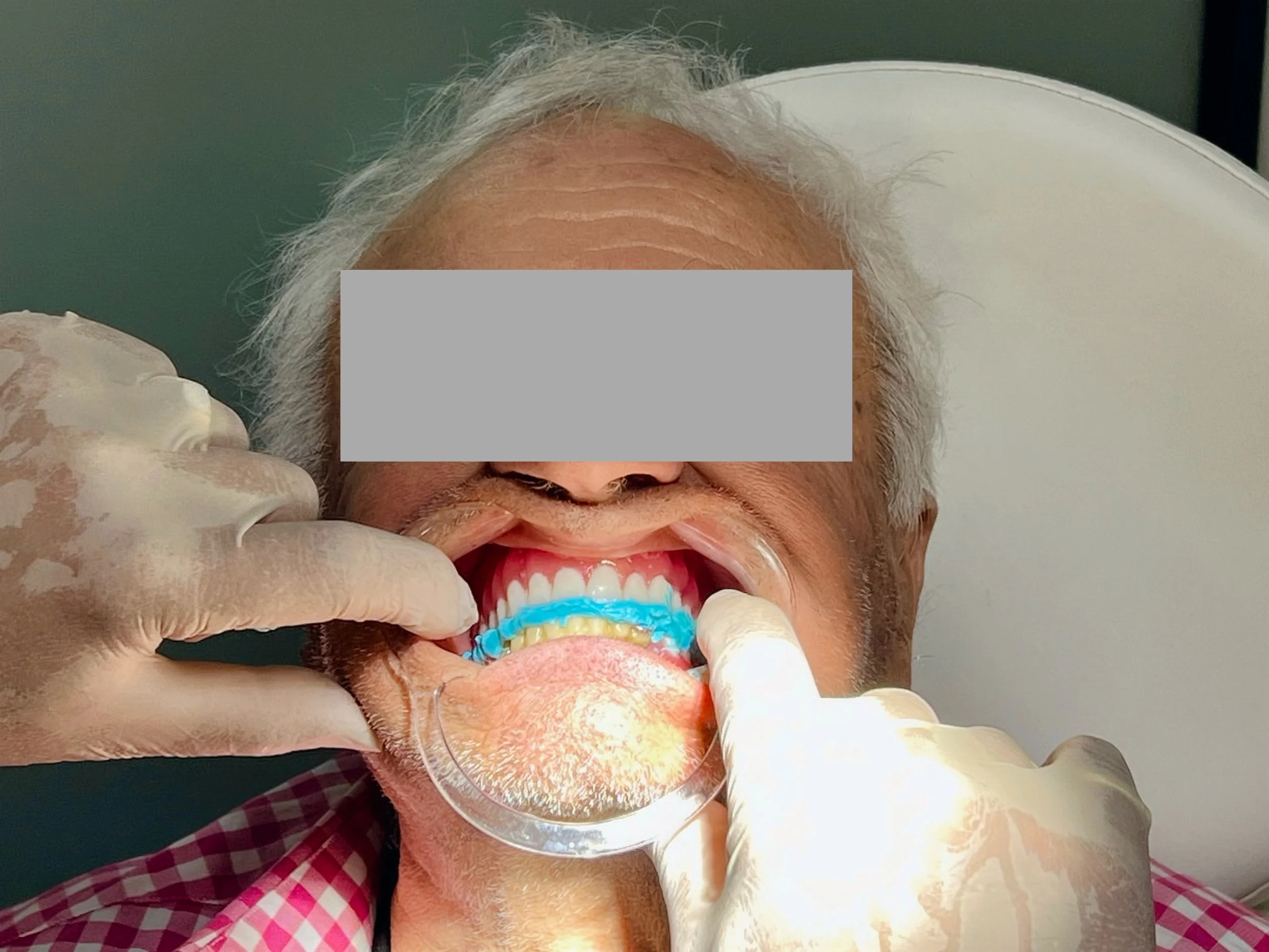 Denture bite registration process.

It highlights the clinical expertise required for accurate denture relining and functional adjustments, reinforcing the brand's authority as a specialized clinic in Victoria serving the Mornington Peninsula and Mel