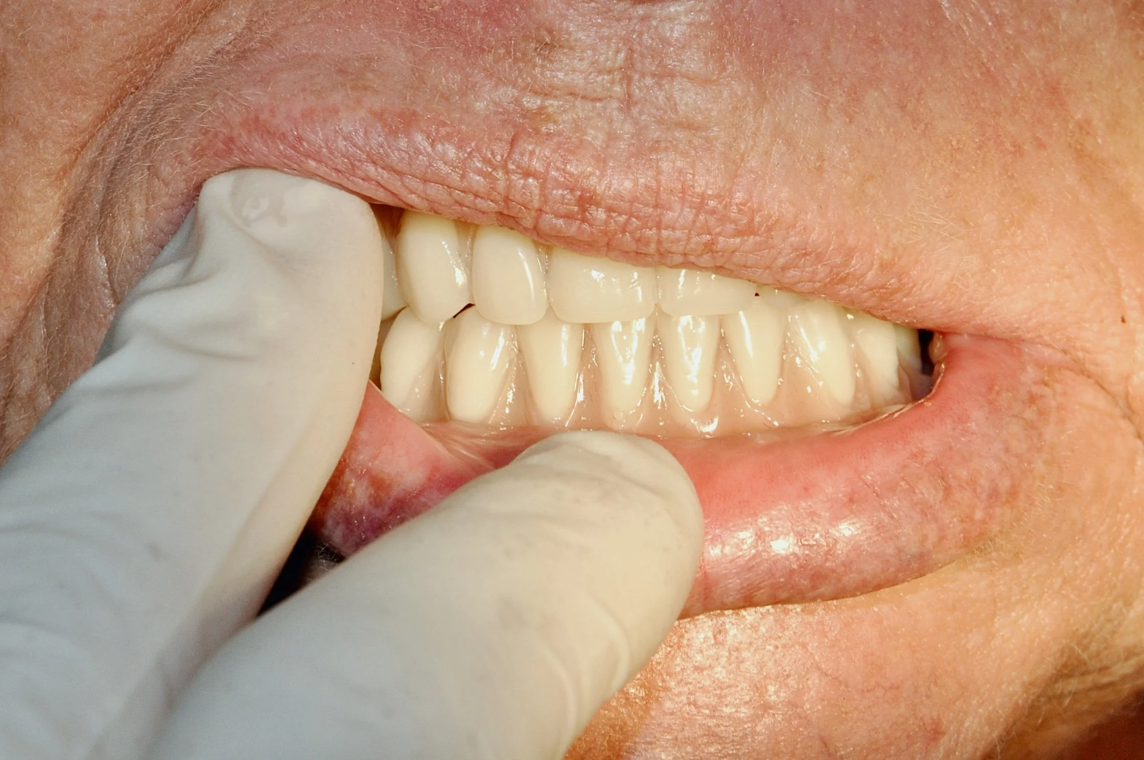 Close-up of a high-precision bite alignment. Our Preston lab focuses on functional excellence, ensuring your dentures feel as natural as they look.