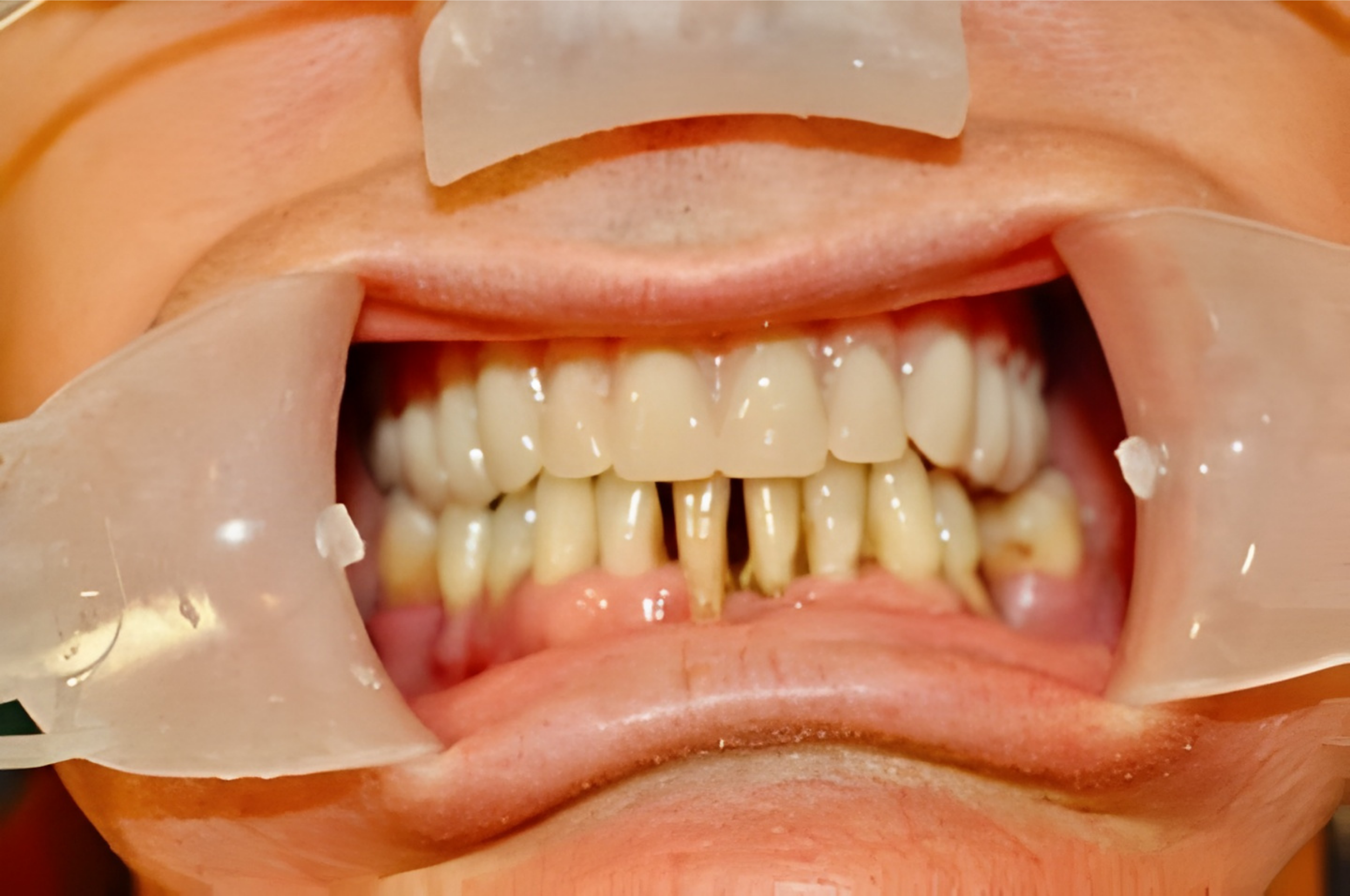 A seamless blend between natural teeth and our full upper denture. Serving Preston, Frankston, and the Mornington Peninsula with aesthetic precision.