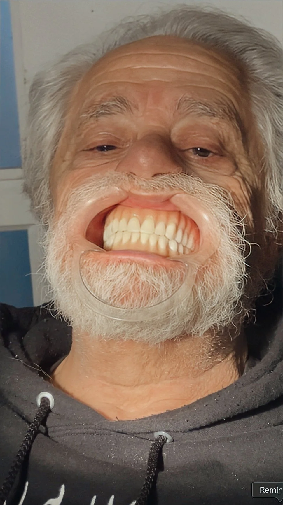 Life like, high quality, accurate full upper and lower denture.