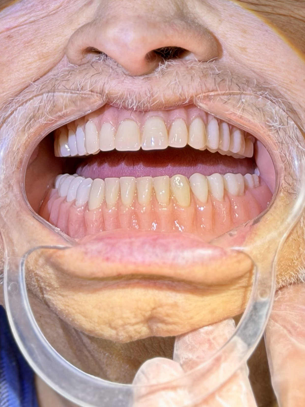 We craft our Full, Upper, and Lower Dentures with paramount precision. Designed to be lifelike and durable, they provide a perfect fit that functions with effortless, natural clarity.
