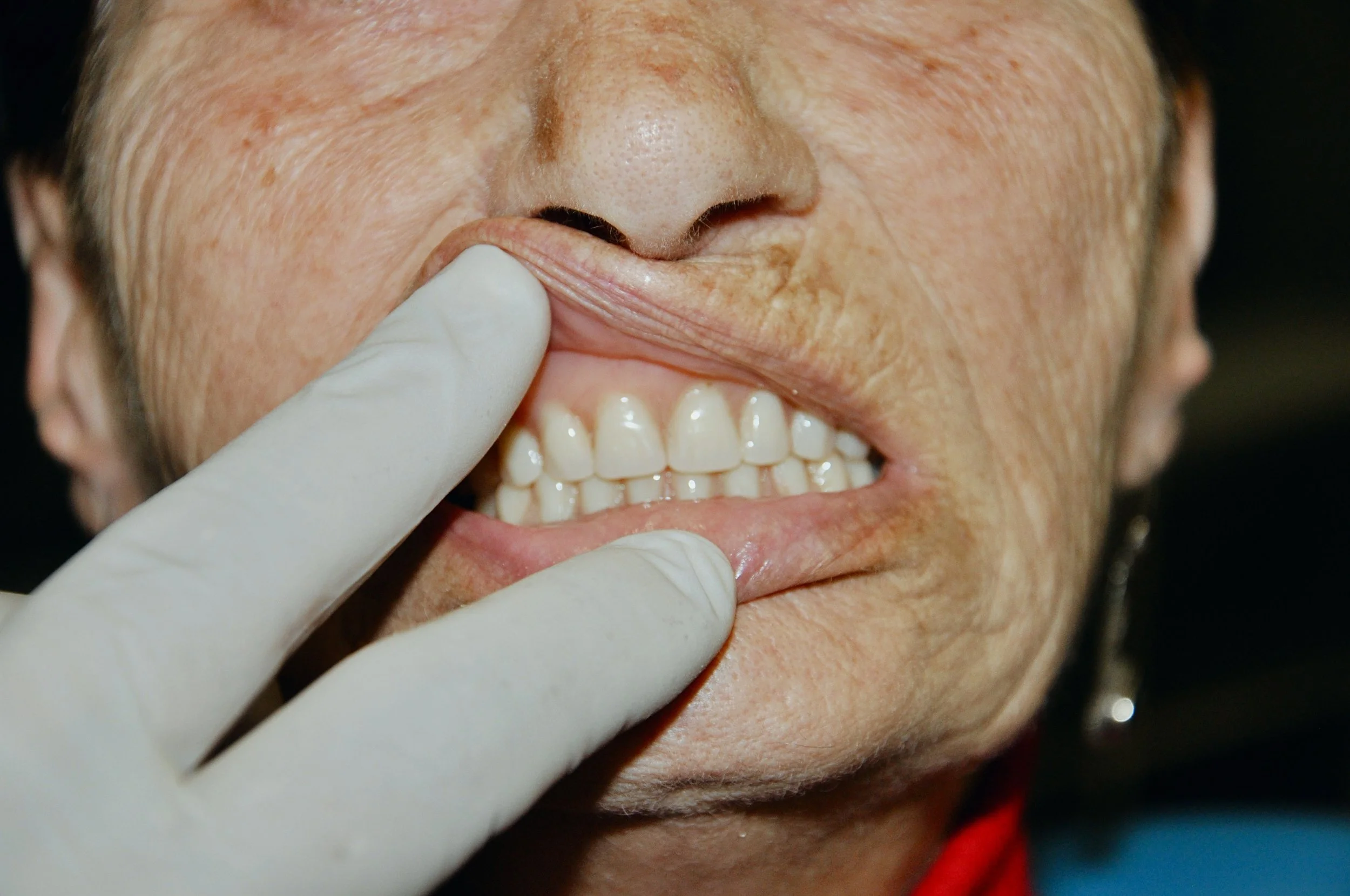 Detailed look at a natural-finish upper denture at our Preston boutique. We focus on seamless gum integration for a lifelike smile