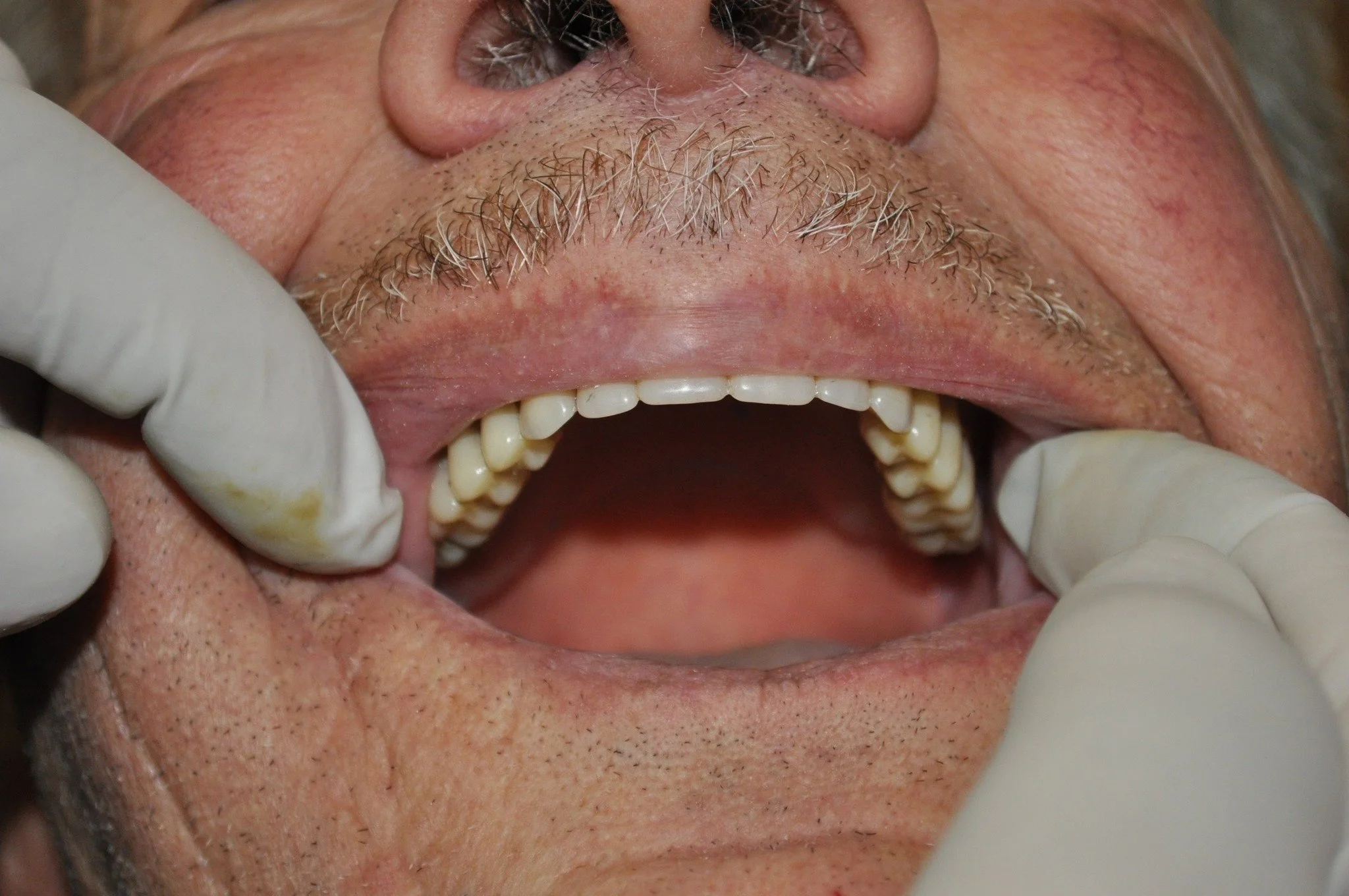 Full upper dentures Melbourne, dental prosthetist Preston.

This image provides detailed clinical evidence of a full upper denture restoration.

It demonstrates the high-precision results of the QiQit system in creating stable, aesthetically pleasing