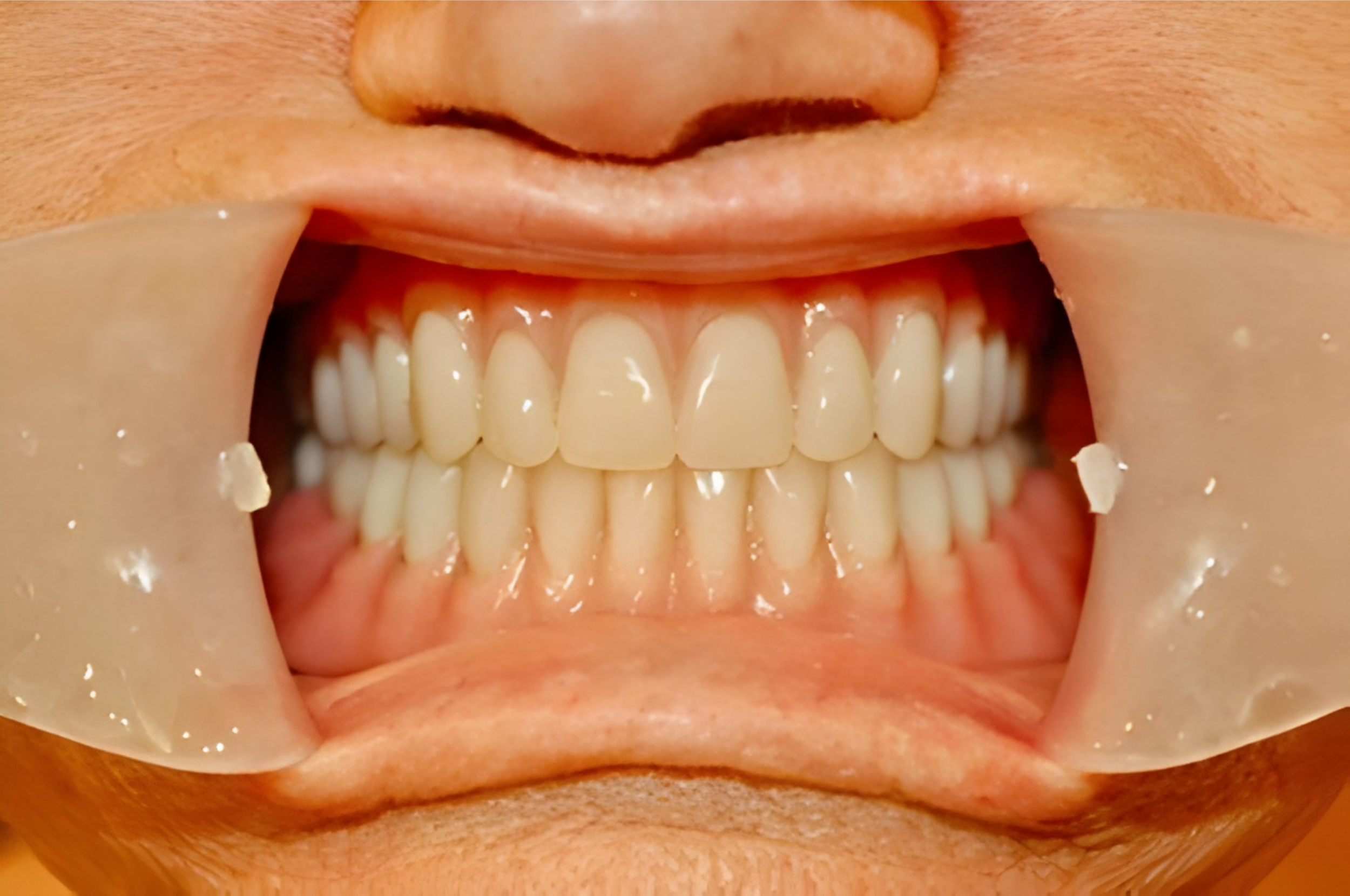 Real patient results.

A clinical close-up of a patient wearing custom-fitted full upper and lower dentures, showcasing realistic tooth alignment and gum shading by SIDISonix Denture Boutique.