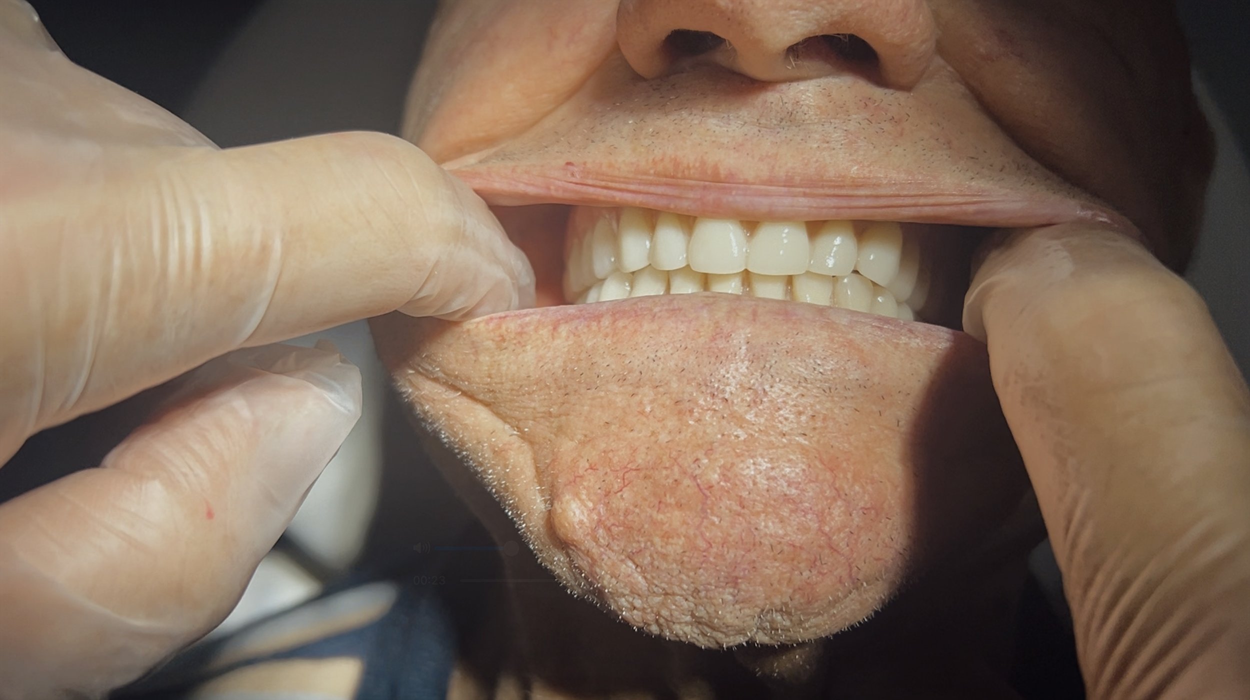 Natural aesthetic dental prosthetics Preston

By showcasing the QiQit system's ability to deliver a stable, natural-looking bite, Dr. Sebastian Riggio is positioned as a leading specialist for complex prosthetic cases in the Melbourne and Mornington 