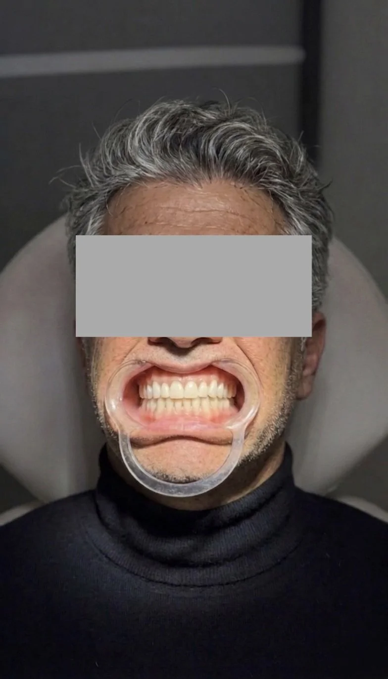 A happy patient received their full upper and lower denture today. the denture is perfect fitting, functional and extremely realistic. 